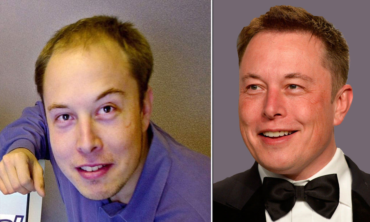 Elon Musk Hair Transplant - relentless-designer